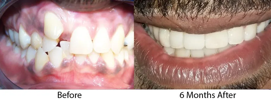 Real patient before and after photographs demonstrating six-month braces results