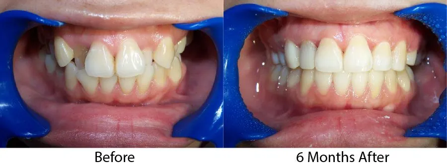 Adult orthodontic patient smiling, six-month braces in Brookline