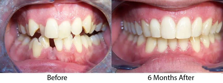 Before and after photos showing an adult patient's smile straightened with six-month braces